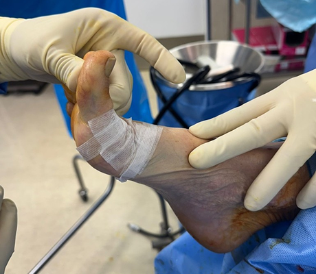 Understanding your bunions/hallux valgus deformity