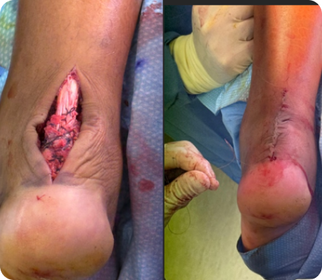 Understanding your bunions/hallux valgus deformity