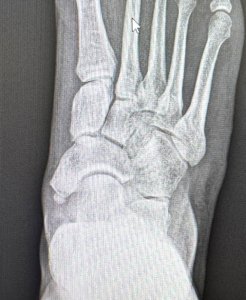 Pre-operative x-ray showing an accessory navicular bone
