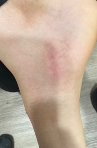 Healed incision on the inside of the foot after accessory navicular excision