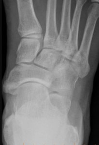 Pre-operative x-ray showing a large type III (cornuate) accessory navicular