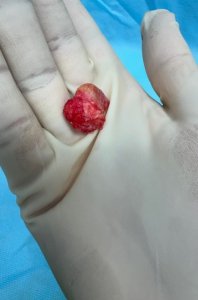 Excised accessory navicular bone held in a gloved hand